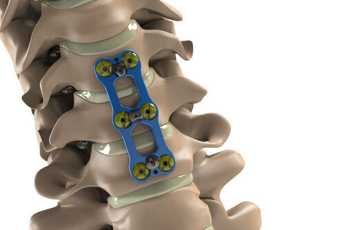 Cirugía percutánea Cirugía percutánea