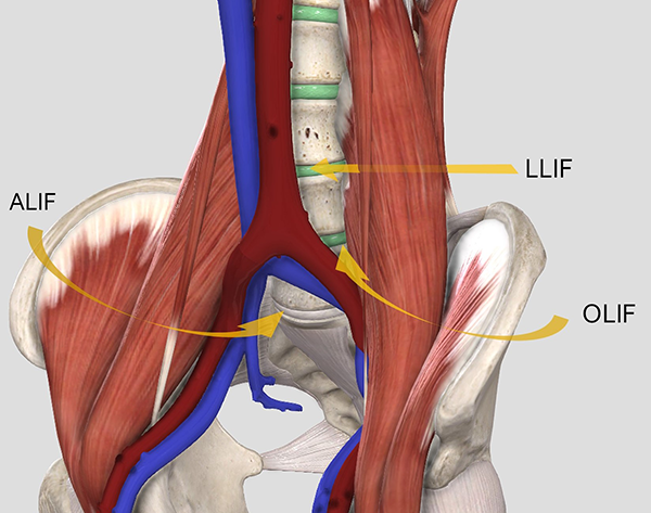 Cirugía de columna Cirugía de columna