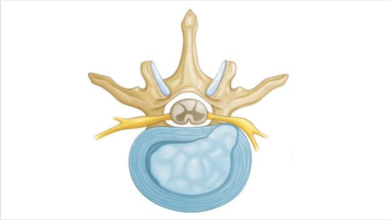 Hernia discal cervical