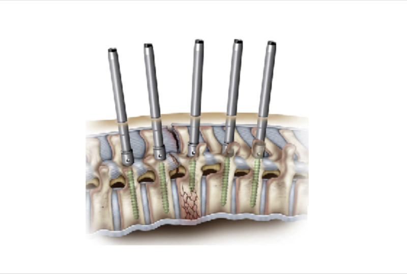 Percutánea Percutánea