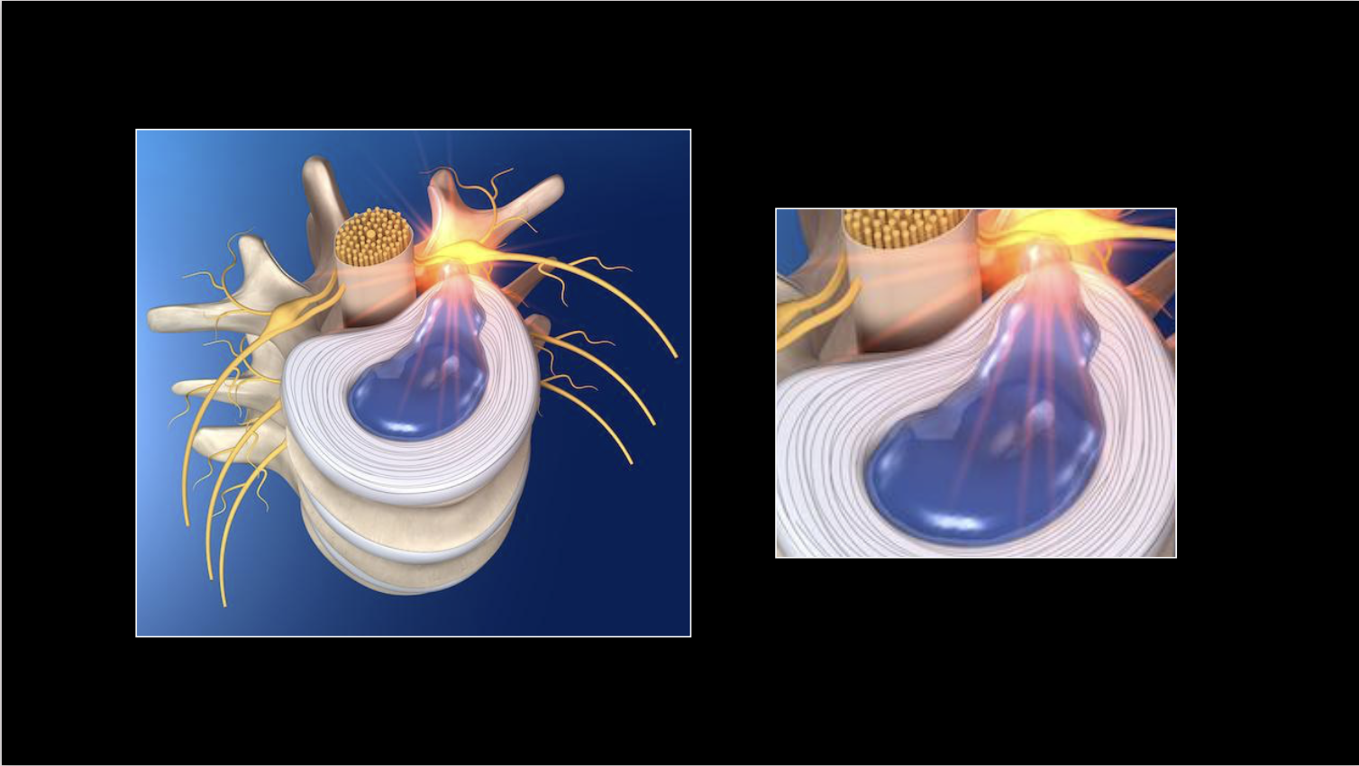 Hernia discal cervical