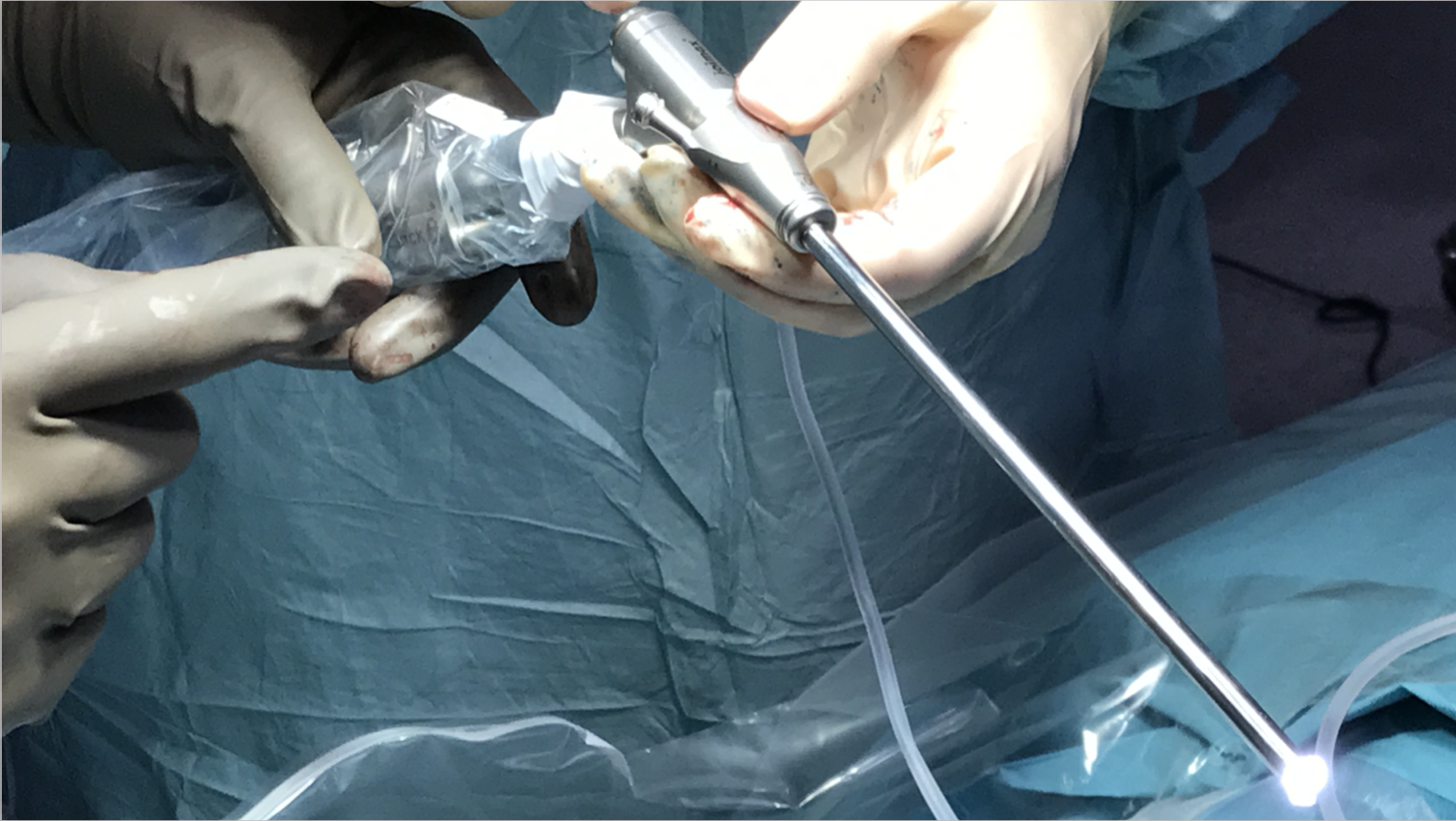 Endoscopio lumbar Endoscopio lumbar