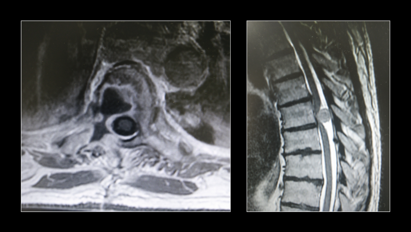 Tumores del raquis vertebral