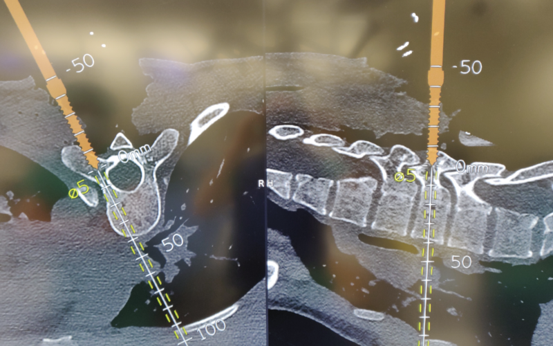 Cirugía de columna Cirugía de columna