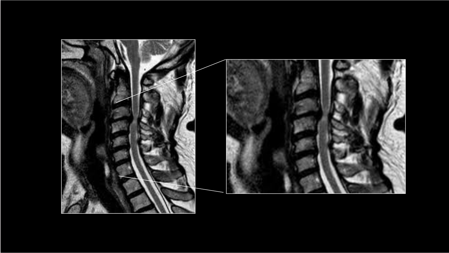 Estenosis de canal cervical