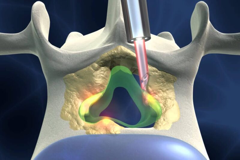 Cirugía percutánea Cirugía percutánea