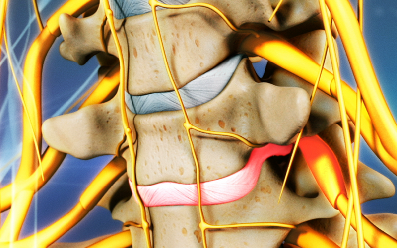 Hernia discal cervical lateral Hernia discal cervical lateral