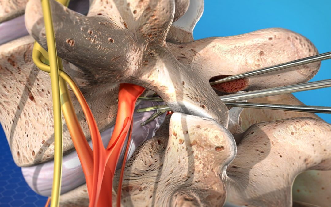 Microdis tapa Microdis tapa