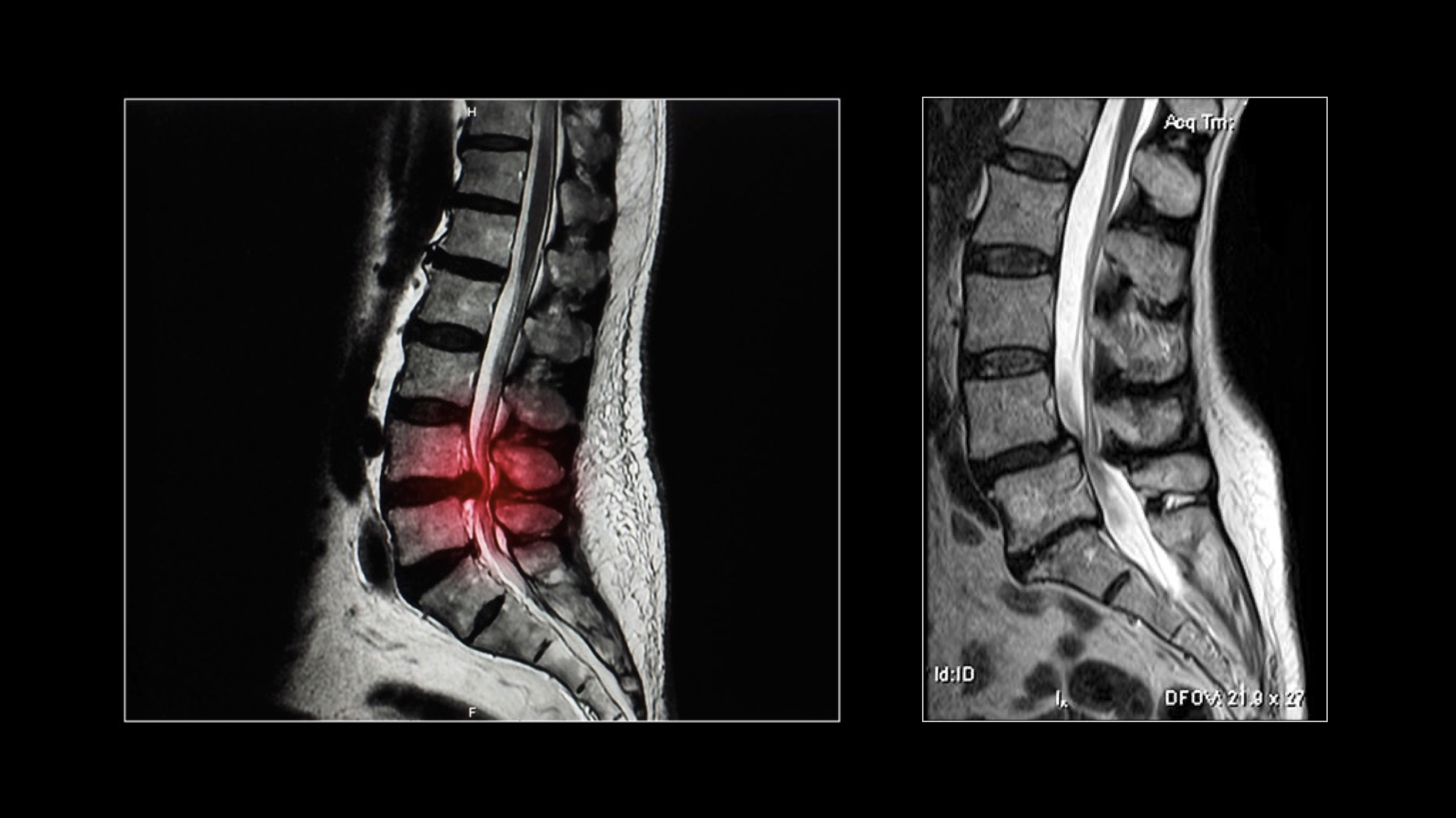 Estenosis de canal lumbar