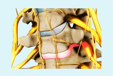 Microdisectomía cervical