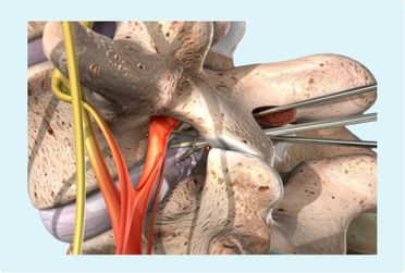 Microdisectomía lumbar