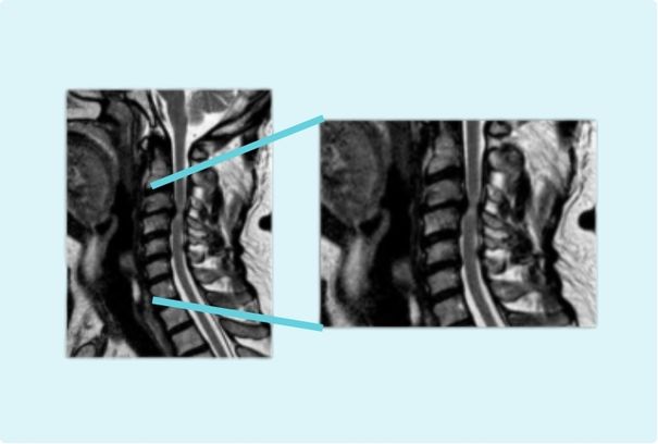 Estenosis de canal cervical
