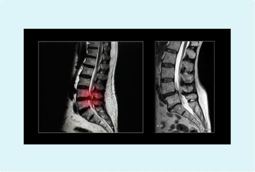 Estenosis de canal lumbar
