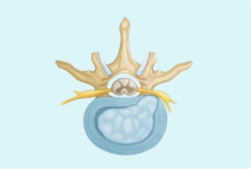 Hernia discal lumbar