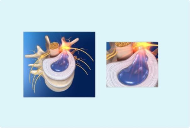 Hernia discal cervical