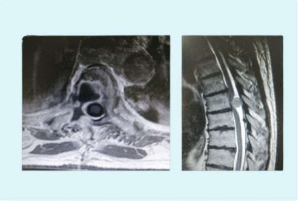 Tumores del raquis vertebral